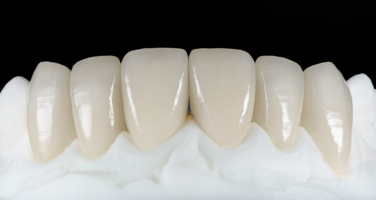 Dental veneers at Maison Dentaire Specialist Clinic, KL