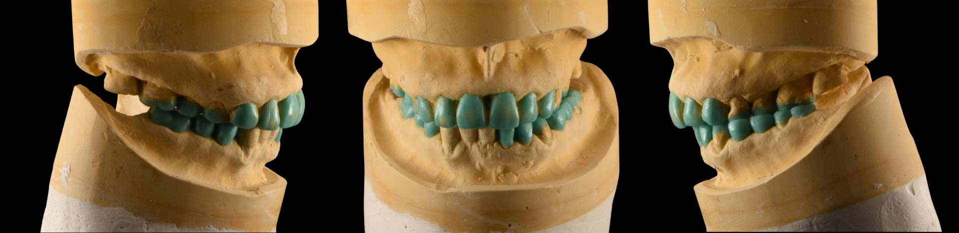 Full Mouth Rehabilitation cases at Maison Dentaire Specialist Clinic, KL