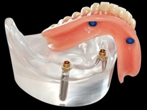 Implant supported over denture at Maison Dentaire Specialist Clinic, KL