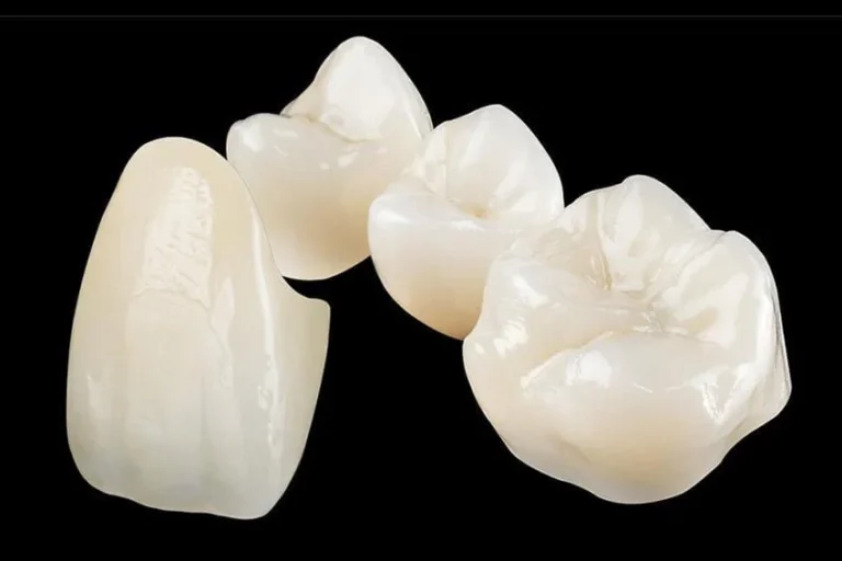 All ceramic or porcelain crown and bridge at Maison Dentaire Specialist Clinic, KL