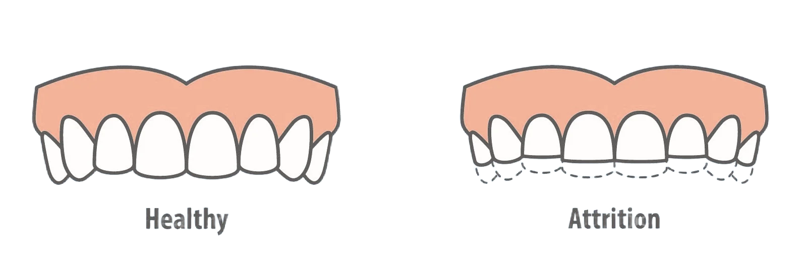 Image showing toothwear, dental attrition from direct contact with other teeth 