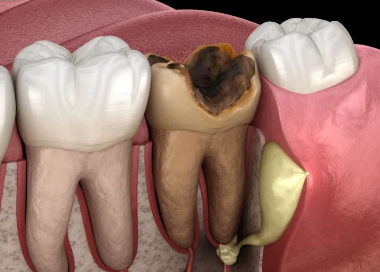 Illustration showing an infected tooth with abscess
