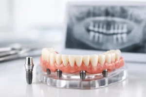 Guide to Full Arch Implants for Lasting Teeth