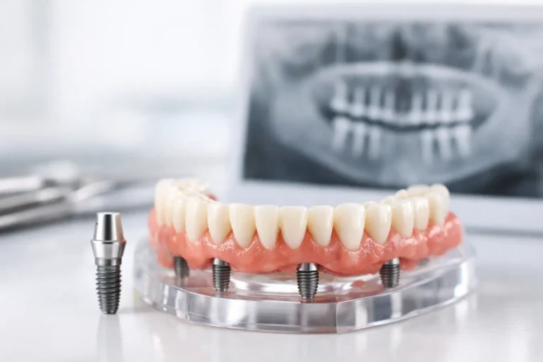 Guide to Full Arch Implants for Lasting Teeth