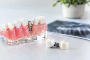 Missing Molar Solutions for Lasting Function