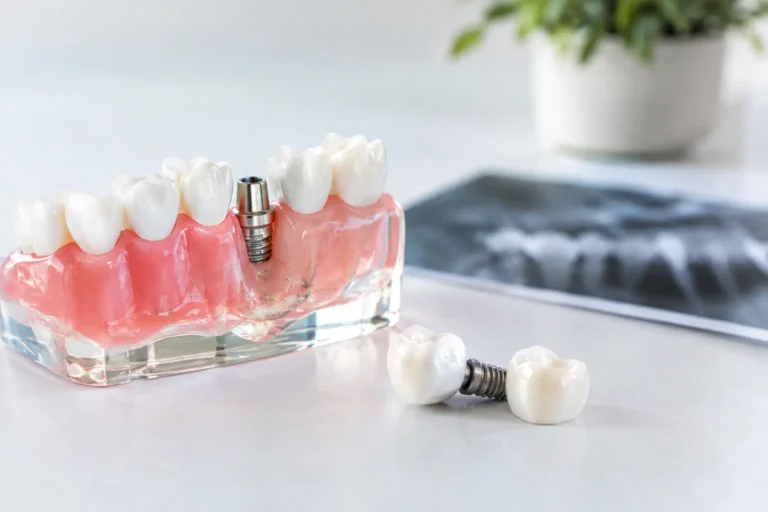 Missing Molar Solutions for Lasting Function